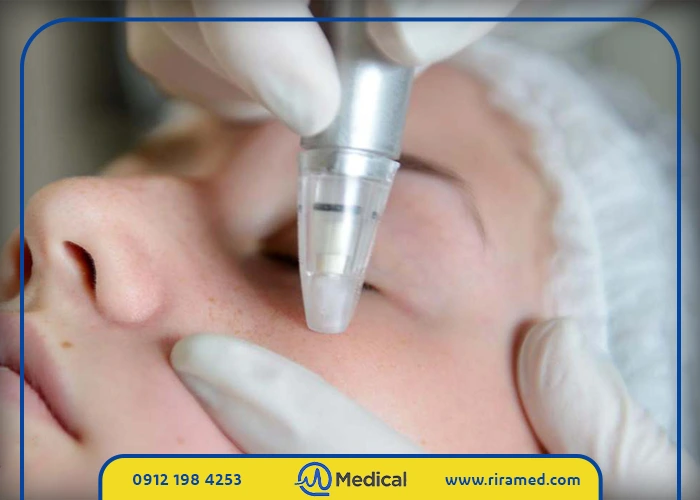 تاثیر میکرودرم خانگی بر مشکلات پوستی