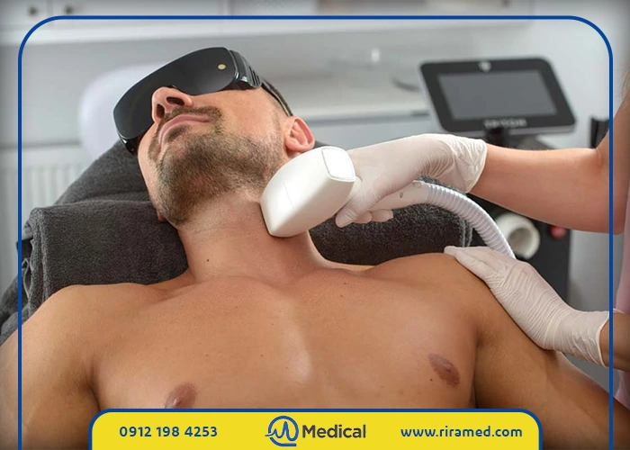 لیزر موهای زائد