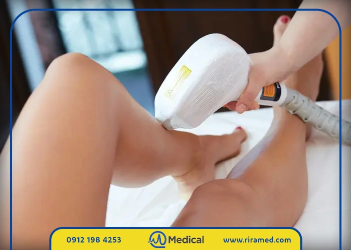 آیا لیزر دائمی است یا موقتی؟