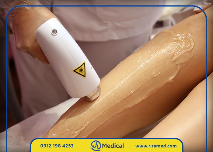 اقدامات لازم برای دستیابی به نتایج دائمی با لیزر موهای زائد