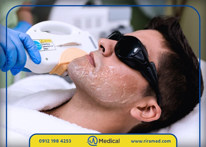 لیزر موهای زائد