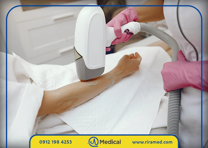 مراقبت‌های لازم بعد از جلسات لیزر موهای زائد برای دستیابی به نتایج دائمی